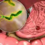 Helicobacter pylori symptômes : comment se manifeste cette infection ?